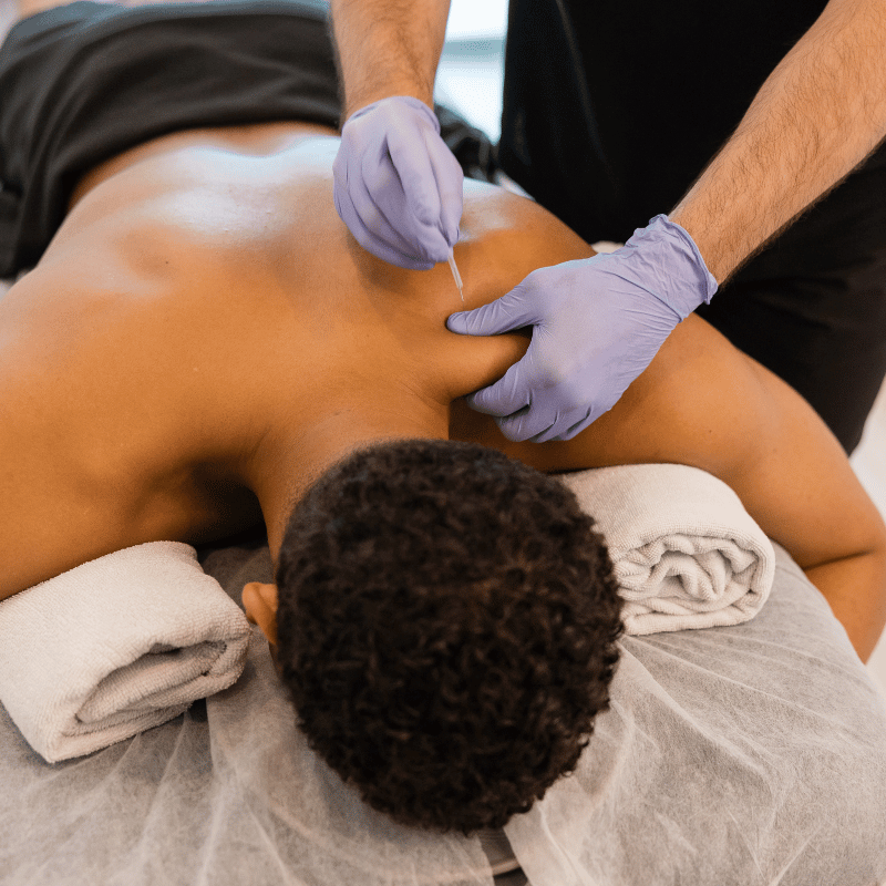 _dry needling (1)